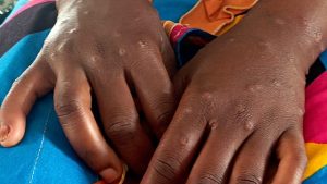 WHO reports rapid spread of Mpox with 17 deaths in Africa over recent weeks